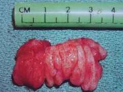 腺体肥大注意什么 腺体肥大的治疗方法