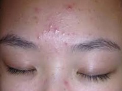 青春痘怎么去 青春痘如何去除