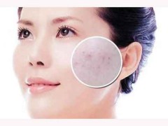 毛孔堵塞怎么办脸部 这些方法能解决毛孔堵塞