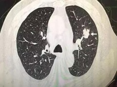 肺部小结节会消失吗 肺结节是怎么回事
