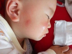 脸肿了怎么办 脸肿了怎么快速消肿
