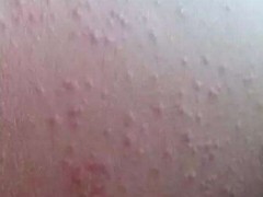 如何预防麻疹 麻疹的症状和治疗