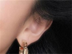 招风耳好不好 招风耳是什么