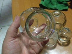 拔火罐后注意事项有哪些?拔火罐的好处有哪些