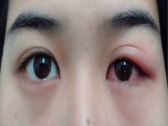 眼睑炎的症状 眼睑炎的快速治疗方法