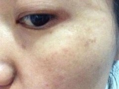 如何去除妊娠斑 用什么方法去除妊娠斑