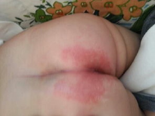 婴儿红屁股护？??