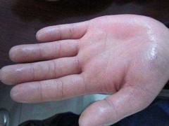 手爱出汗是怎么回事 手爱出汗的原因