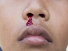 擤鼻涕出血是什么原因 擤鼻涕出血怎么回事