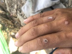寻常疣原因引起的