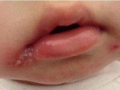 宝宝烂嘴角怎么办 小孩烂嘴角是什么回事