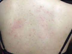 体内湿气重会长痘吗 湿气重的表现