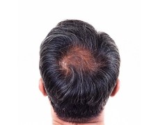 飞机打多了白头发多可以恢复吗 用手过度白发多的恢复措施